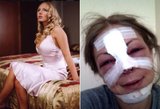 Rusiją šokiravo pop žvaigždę suniokojusių plastinių operacijų vaizdai