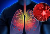 Plaučių vėžys – ne tik rūkančiųjų liga: simptomai, į kuriuos negalima numoti ranka 