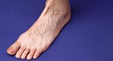 3 ženklai kojose išduoda agresyvią venų ligą: pastebėkite laiku (nuotr. 123rf.com)