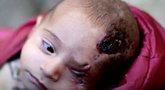 Vieną akį praradęs sirų kūdikis tapo apgulties simboliu  