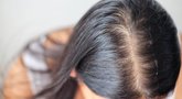 Plaukų slinkimas (nuotr. Shutterstock.com)