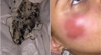 Paauglė skaudžiai nudegė veidą, kai naktį užsidegė jos „iPhone“ įkroviklis (nuotr. facebook.com)