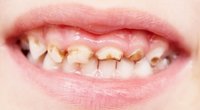Nesveiki dantys (Nuotr. 123rf.com)  