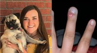 Laura Nichols (18) vaizdo įrašu programėlėje „TikTok“ pasidalino įspėjimu apie tai, kaip dėl nagų kramtymo sukeltos infekcijos ji vos neprarado rodomojo piršto (nuotr. facebook.com)