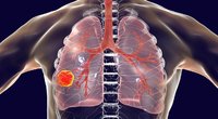 Plaučių vėžys (nuotr. 123rf.com)