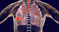 Plaučių vėžys (nuotr. 123rf.com)