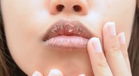 Sausos lūpos (nuotr. Shutterstock.com)