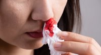 Kraujas iš nosies (nuotr. Shutterstock.com)