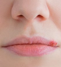 Lūpų pūslelinė (nuotr. shutterstock.com)