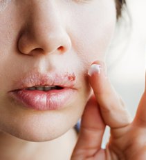 Lūpų pūslelinė (nuotr. Shutterstock.com)