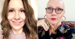 Kaunietė neteko visų savo plaukų per 2 savaites: „Ne, tai ne vėžys"