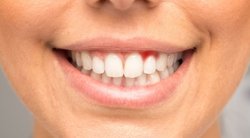 Kraujuojančios dantenos (nuotr. Shutterstock.com)