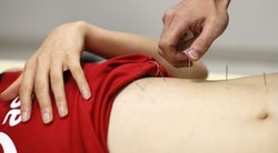 Akupunktūra (nuotr. Reuters/ Scanpix)  