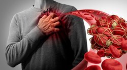 Klastingus kraujo krešulius išduoda šie simptomai: nenumokite ranka  (nuotr. Shutterstock.com)