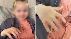 Po kontakto su Sosnovskio barščiu mergaitei ant rankos atsirado didelės pūslės (nuotr. facebook.com)