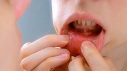 Kaip elgtis, kad burnos žaizdelės užgytų greičiau? (nuotr. Shutterstock.com)