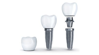 Kokio amžiaus žmonės gali susidėti dantų implantus?