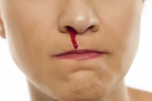 Kraujas iš nosies  (nuotr. 123rf.com)