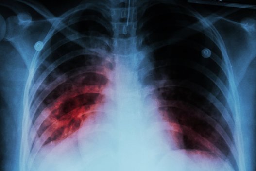 Tuberkuliozė (nuotr. Fotolia.com)