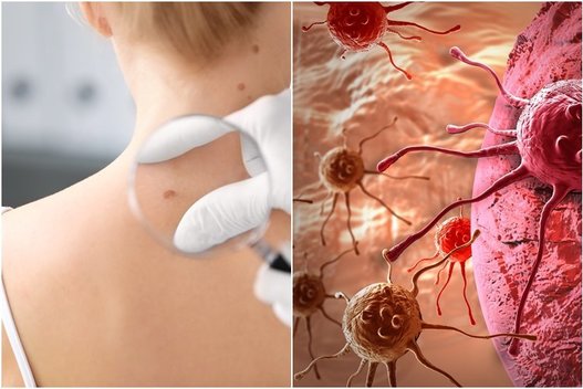 Įspėja dėl agresyvaus odos vėžio: gydytojai ragina šiukštu neskubėti šalinti nepatinkančių apgamų (nuotr. 123rf.com)