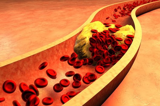Cholesterolis (nuotr. 123rf.com)