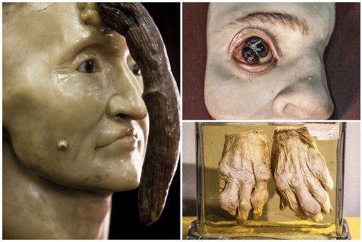 Deformuoti kūnai ir ir kūdikiai stiklainiuose: chirurgo eksperimentai kelia siaubą (Mütter Museum of Philadelphia nuotr.) (nuotr. Organizatorių)