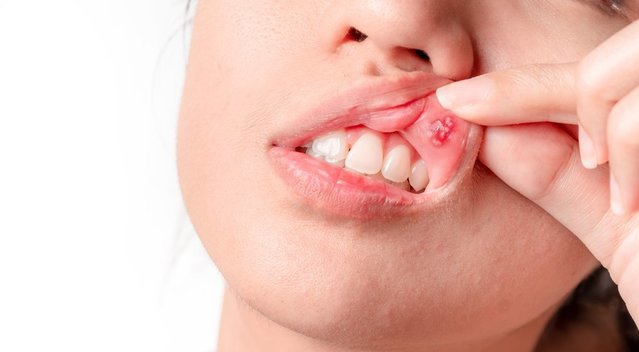 Pastebėjote žaizdeles burnoje? Medikė pasakė, ko imtis ir kodėl delsti pavojinga (nuotr. Shutterstock.com)