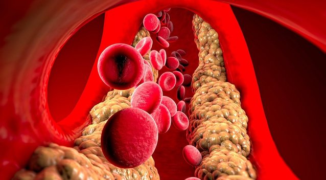 Aukštą cholesterolį išduoda vos keli ženklai: pastebėkite laiku (nuotr. 123rf.com)