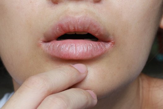 Žaizdos burnoje (nuotr. Shutterstock.com)