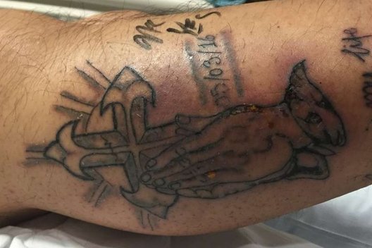 Tatuiruotę pasidaręs jaunas vyras mirė pasigavęs mirtiną infekciją (nuotr. iflscience.com) (nuotr. Gamintojo)