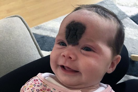 Mergaitė gimė su dideliu apgamu ant veido  