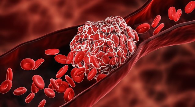 Mirtinus kraujo krešulius išduoda šie ženklai: pastebėkite laiku (nuotr. 123rf.com)