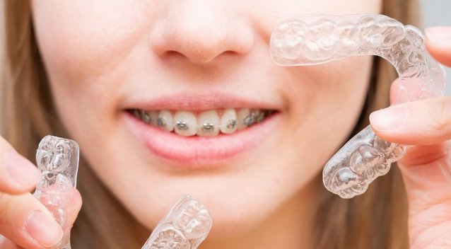 Dantų tiesinimas (nuotr. Shutterstock.com)