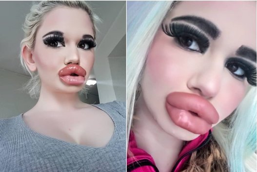 Didžiausias lūpas pasaulyje turinti mergina neketina sustoti (nuotr. Instagram)