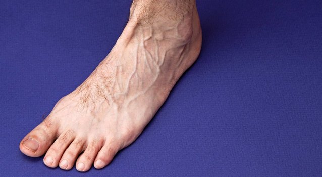 3 ženklai kojose išduoda agresyvią venų ligą: pastebėkite laiku (nuotr. 123rf.com)