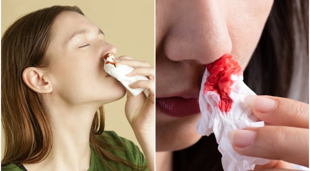 Nenumokite ranka į kraują iš nosies: medikas atskleidė 1 didžiausią klaidą (nuotr. Shutterstock.com)
