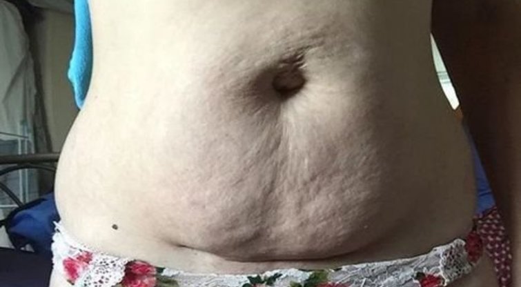 Moters kūnas po gimdymo (nuotr. Instagram)