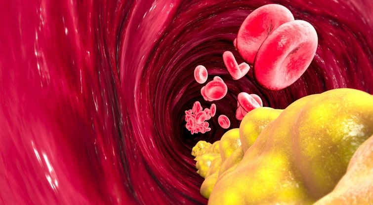 Padidėjusį cholesterolio kiekį išduoda 1 ženklas: pastebėkite laiku (nuotr. Shutterstock.com)