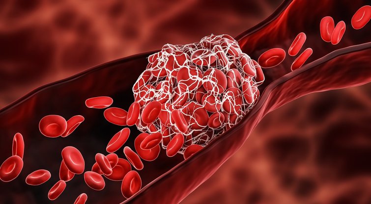 Šie produktai gali paskatinti kraujo krešulius: venkite jų (nuotr. 123rf.com)