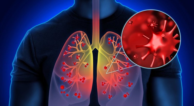 Plaučių uždegimas  (nuotr. Shutterstock.com)