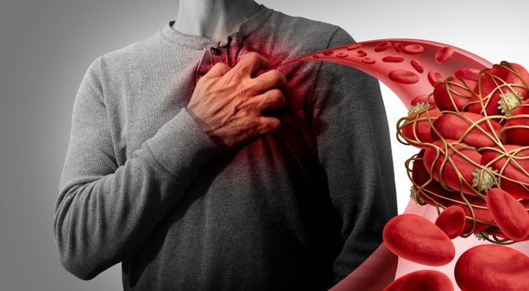 Kraujo krešulius išduoda vos keli simptomai: kelią mirčiai užkirskite laiku (nuotr. Shutterstock.com)