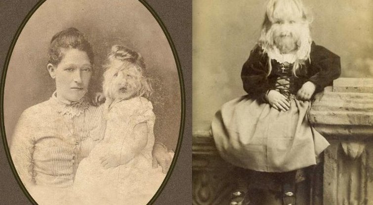 Nuotrauka iš praeities: „Vilkolakio sindromą“ turinti mergaitė tapo šiurpia sensacija  