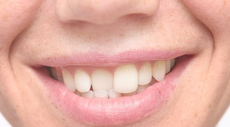 Kreivi dantys (nuotr. Shutterstock.com)