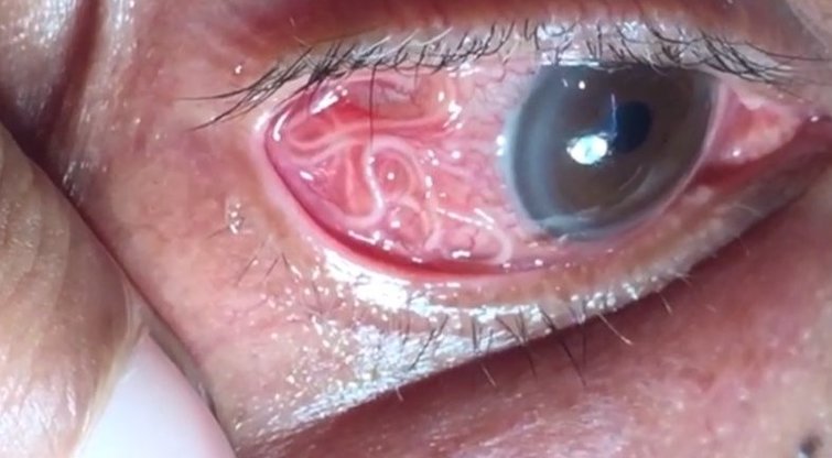 Vyro akyje – šlykštus gyvis: medikai turėjo tai pašalinti kuo greičiau (nuotr. YouTube)