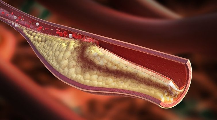 Cholesterolis (nuotr. Shutterstock.com)