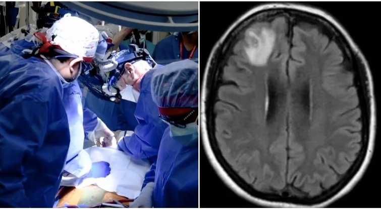8 cm ilgio radinys moters smegenyse šokiravo medikus: tai matė pirmą kartą (nuotr. stop kadras, SCANPIX)  