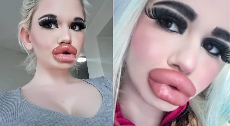 Didžiausias lūpas pasaulyje turinti mergina neketina sustoti (nuotr. Instagram)