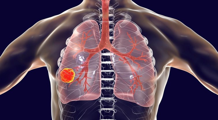 Šie ženklai išduoda plaučių vėžį: užkirskite kelią mirčiai laiku (nuotr. 123rf.com)