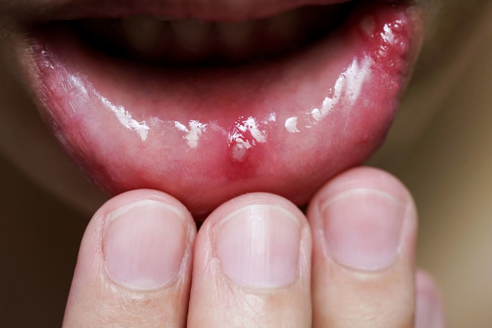 Skaudi žaizdelė burnoje gali išduoti nemalonią ligą
