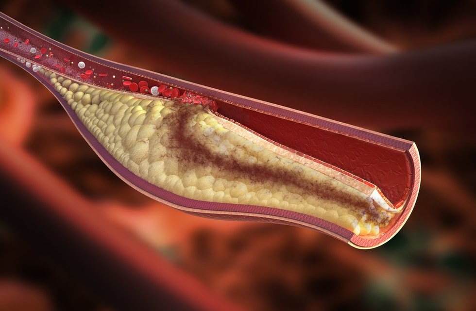 Cholesterolis (nuotr. Shutterstock.com)
